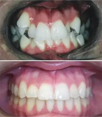 Severe Crowding (Extraction Case)
