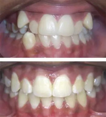 Crowding (Non-Extraction)