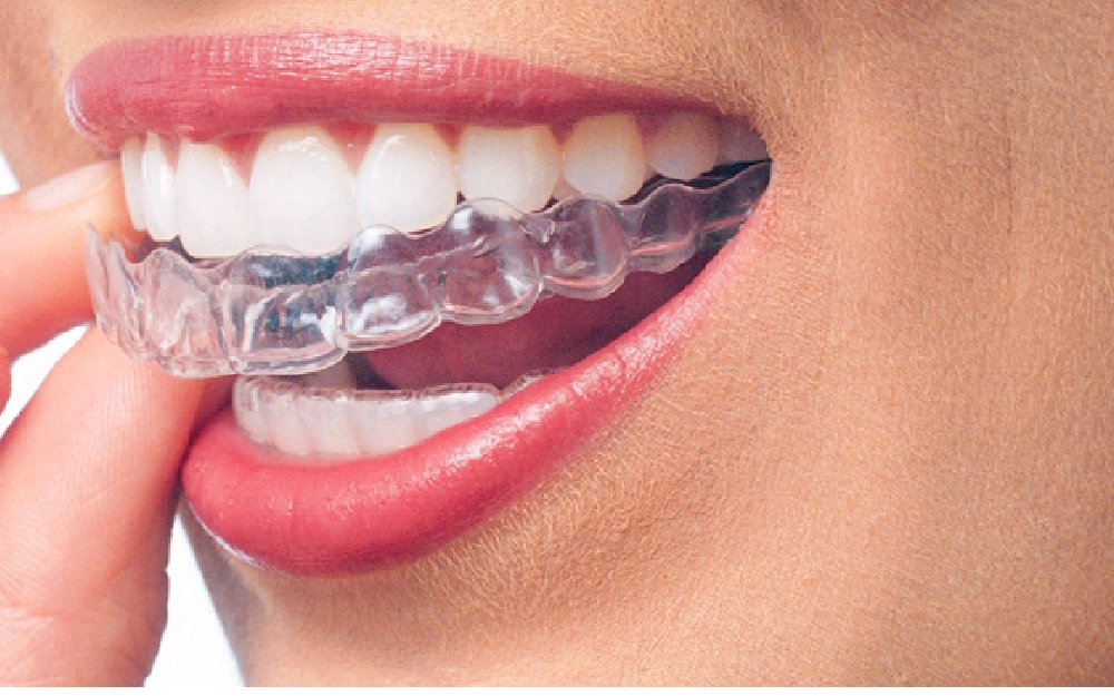 Essix Retainer 3