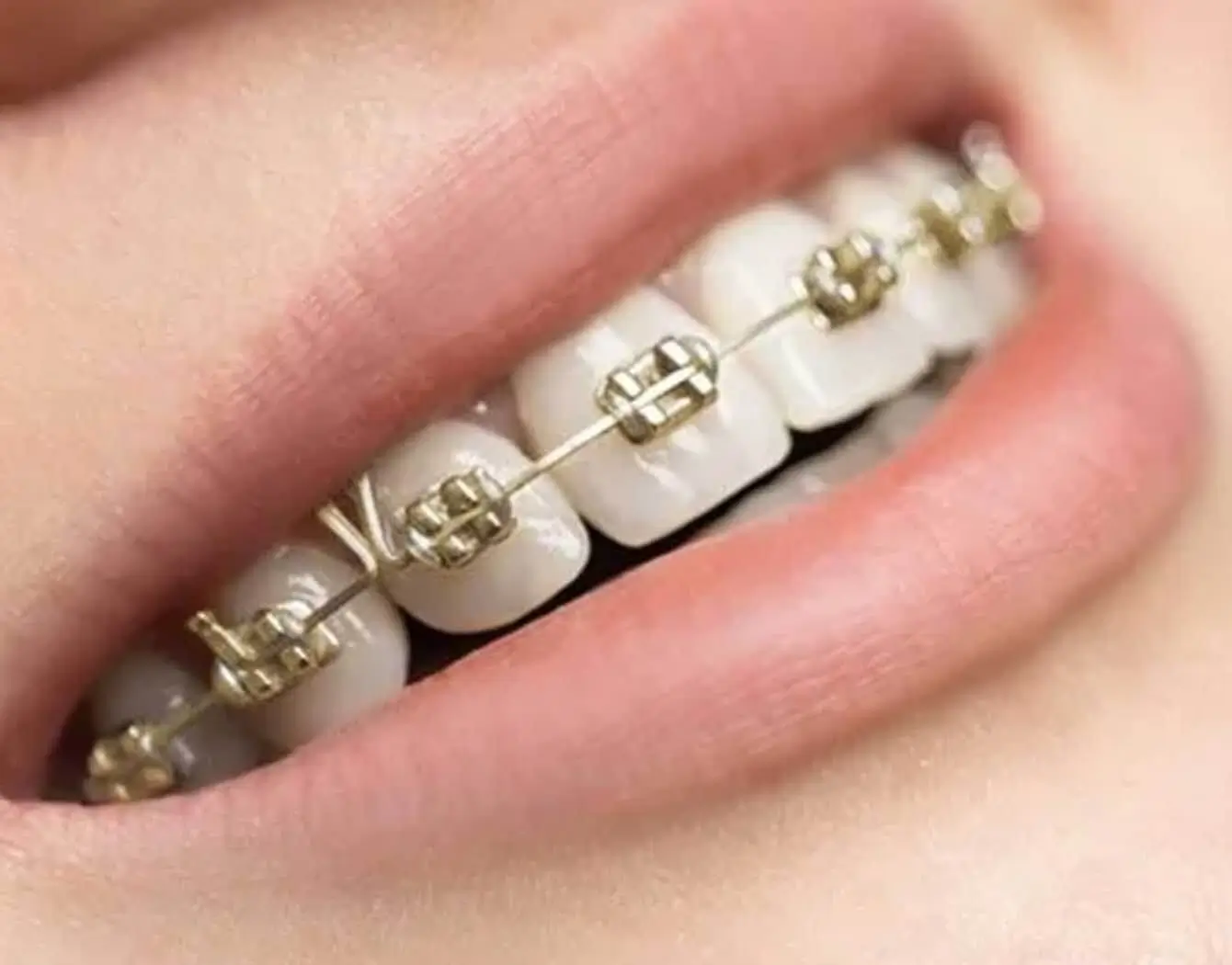 Close up of Iconix Gold Braces