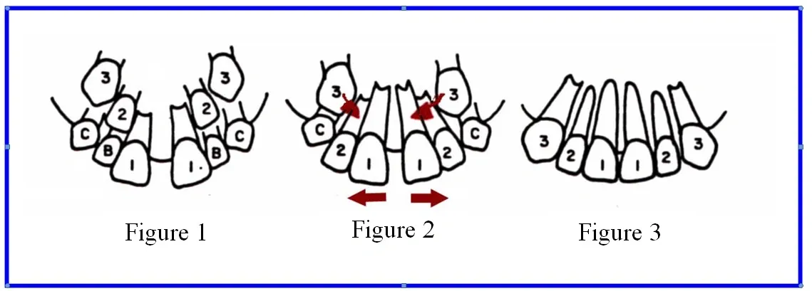 Natural Tooth Spacing Diagram