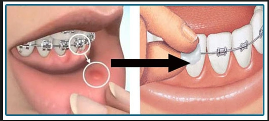Mouth sores from braces