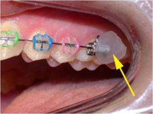 Applying wax to braces