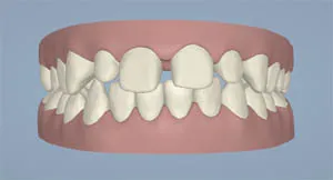 Will the Space Between Front Teeth Close Itself?